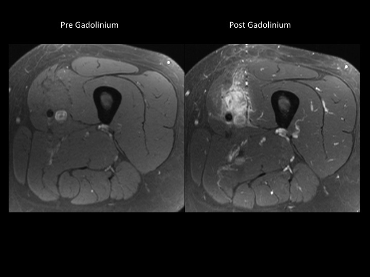Figure 4 for case myositis ossificans